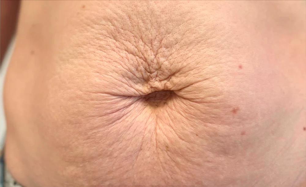 Flacidez abdominal, tratado con Fibroblast — antes